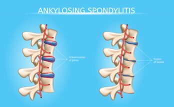 Ankylosing Spondylitis