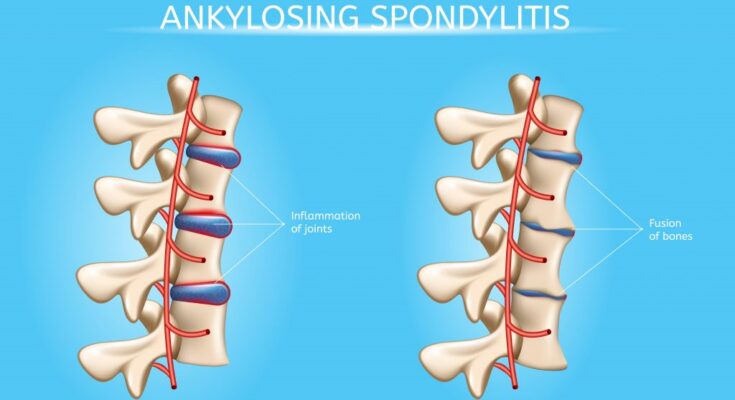 Ankylosing Spondylitis