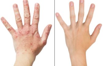 Atopic Dermatitis