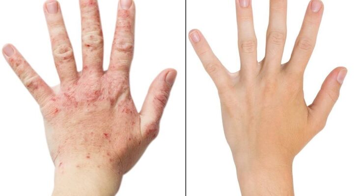 Atopic Dermatitis