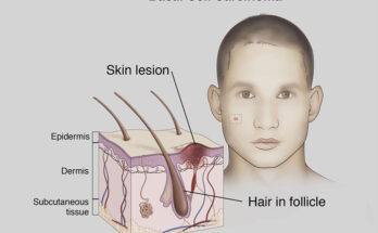 Basal Cell Carcinoma