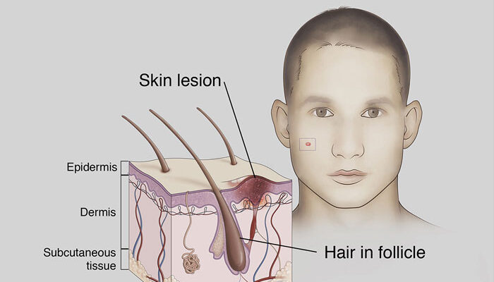 Basal Cell Carcinoma