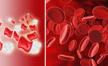 Beta-Thalassemia (B-Thal)