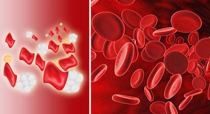 Beta-Thalassemia (B-Thal)