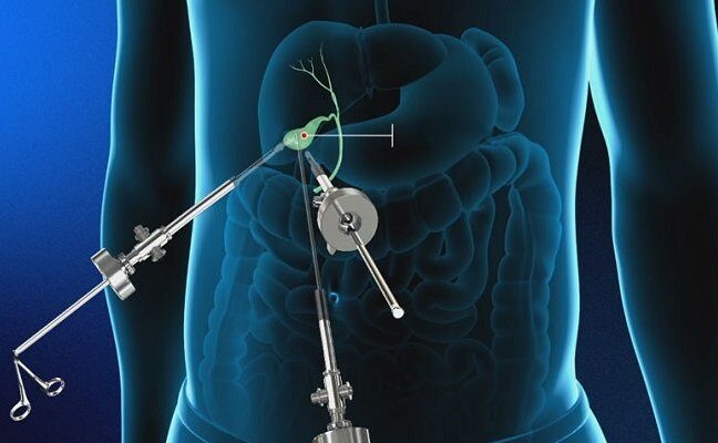 Cholecystectomy Devices Market