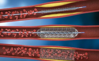 Global Angioplasty Balloons Market