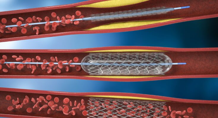 Global Angioplasty Balloons Market