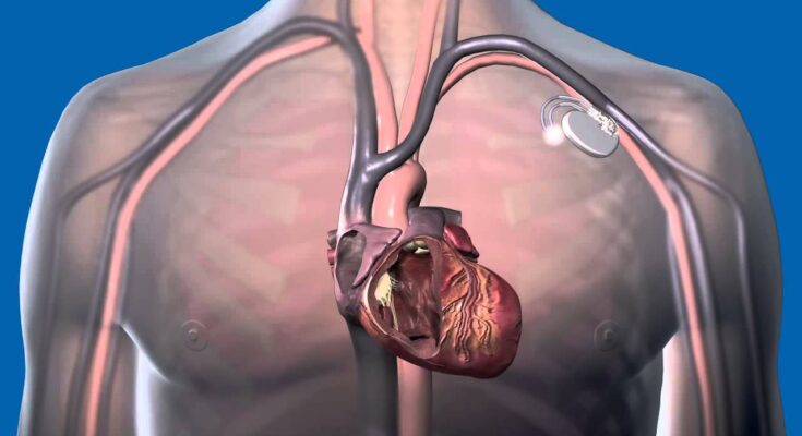 Global Cardiac Resynchronization Therapy Market