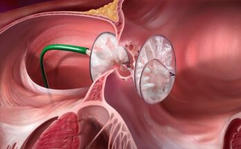 Heart Closure Devices Market