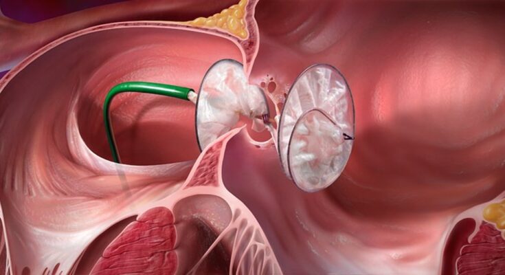 Heart Closure Devices Market