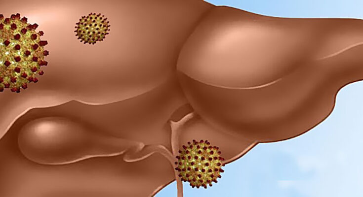 Hepatitis E Diagnostics