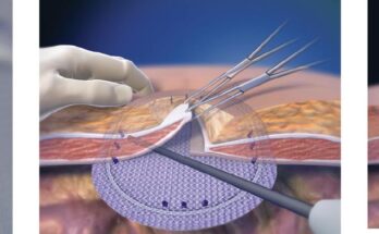 Hernia Mesh Devices