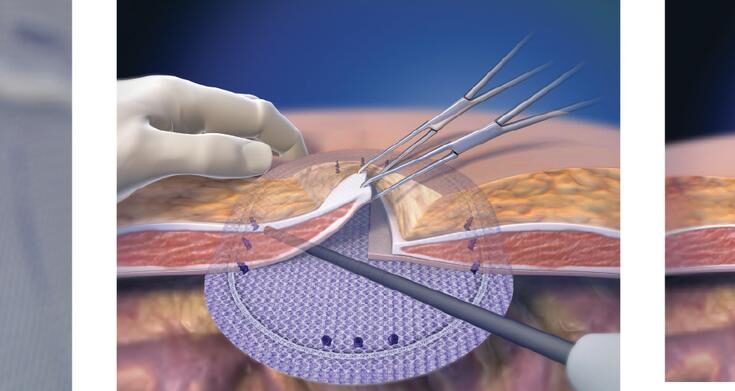 Hernia Mesh Devices