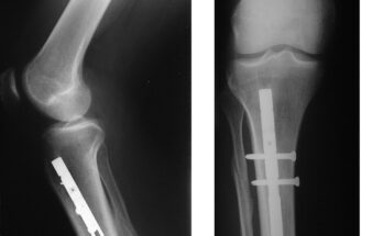 Osteosynthesis Devices