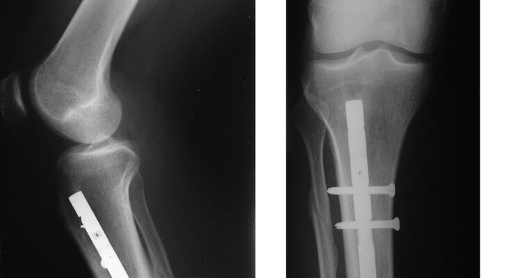 Osteosynthesis Devices