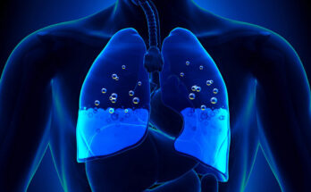 Pulmonary Edema Therapeutics Market