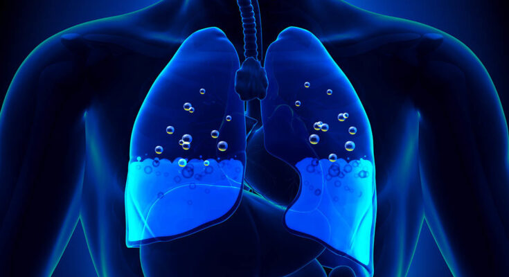 Pulmonary Edema Therapeutics Market