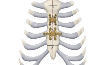 Sternal Closure Systems Market