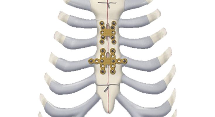 Sternal Closure Systems Market