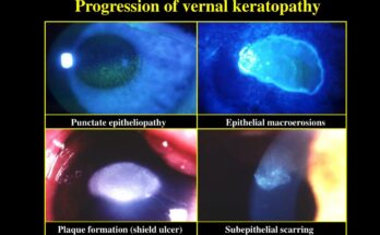 Vernal Keratoconjunctivitis Market