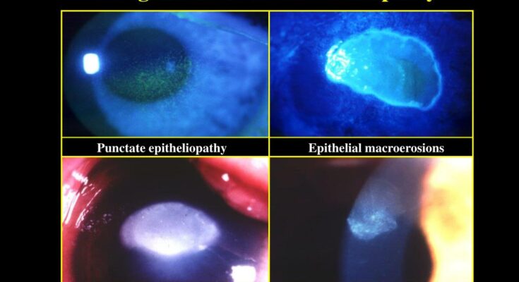 Vernal Keratoconjunctivitis Market