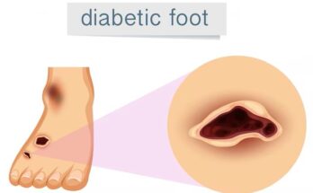 Diabetic Foot Ulcer Treatment Market Size