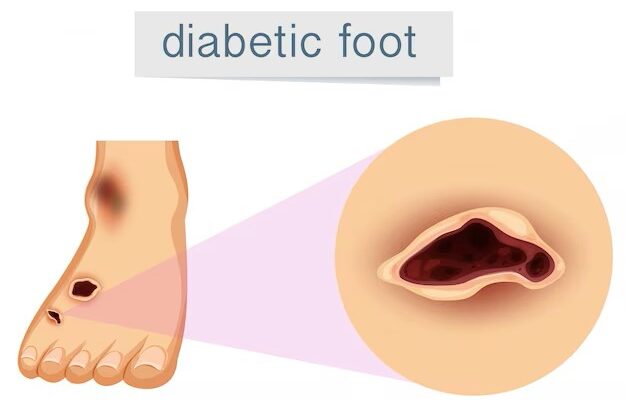 Diabetic Foot Ulcer Treatment Market Size