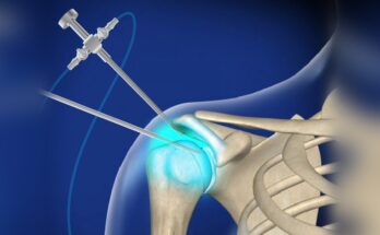 Arthroscopy Fluid Management Disposables