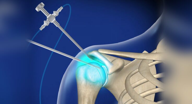 Arthroscopy Fluid Management Disposables