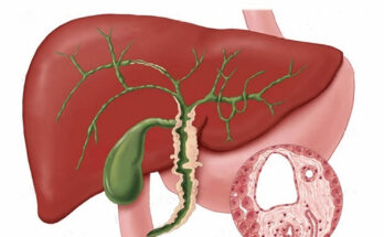 Cholangiocarcinoma Market