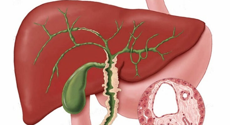 Cholangiocarcinoma Market