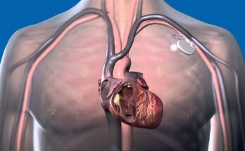 Global Severe Acute Respiratory Syndrome (SARS) Treatment Market