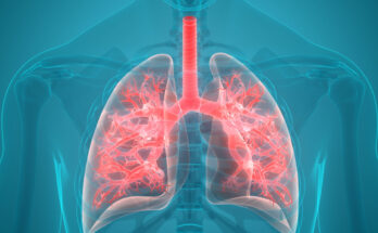 Global Pulmonary Edema Therapeutics Market