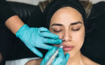 Hyaluronic Acid-Based Dermal Fillers