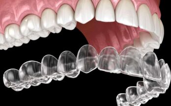 Clear Aligners