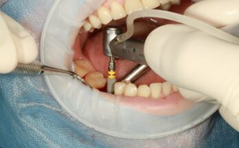 Dental Implants Market