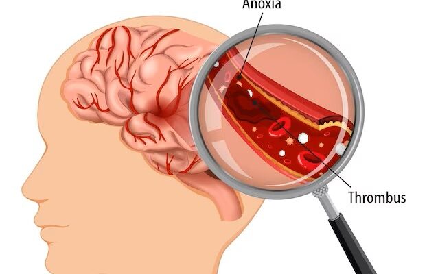 Acute Ischemic Stroke Diagnosis Market Size