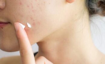 Global Acne Medicine Market