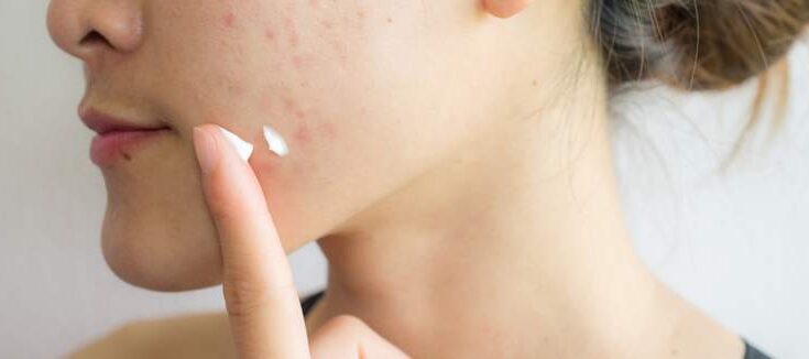 Global Acne Medicine Market