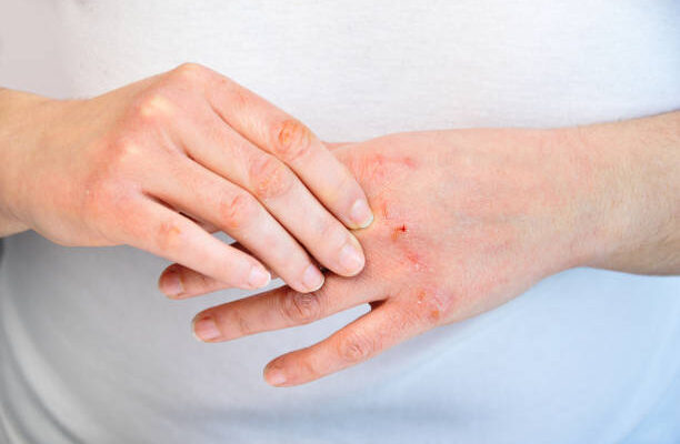 Atopic Dermatitis Global Market