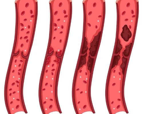 Venous Thromboembolism Market