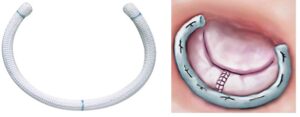 Annuloplasty Rings Market 