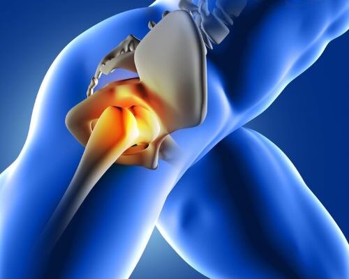 Global Hip Replacement Market Size