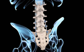 Pedicle Screw Systems Market