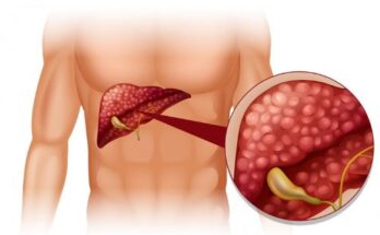 Unresectable Hepatocellular Carcinoma Market Insights, Forecast Analysis 2033