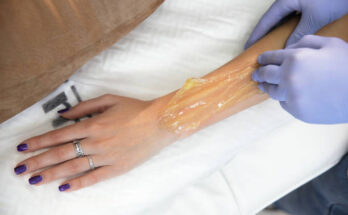 Sugaring Hair Removal Market